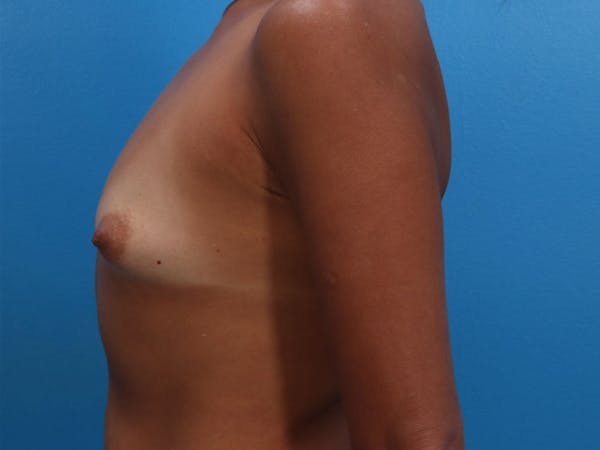 Breast Lift Before & After Gallery - Patient 143775495 - Image 9