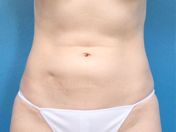 Liposuction Before & After Gallery - Patient 143825678 - Image 1
