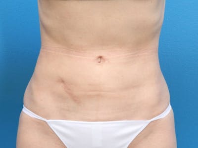 Liposuction Before & After Gallery - Patient 143825678 - Image 2