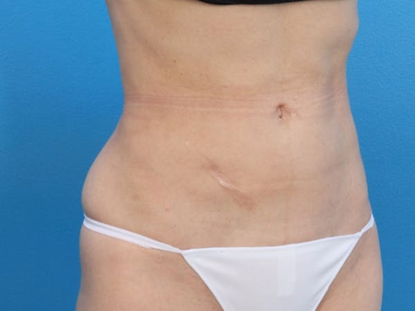 Liposuction Before & After Gallery - Patient 143825678 - Image 4