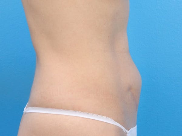 Liposuction Before & After Gallery - Patient 143825678 - Image 5