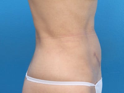 Liposuction Before & After Gallery - Patient 143825678 - Image 6