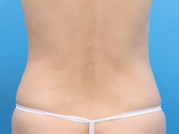 Liposuction Before & After Gallery - Patient 143825678 - Image 7