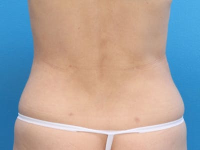 Liposuction Before & After Gallery - Patient 143825678 - Image 8