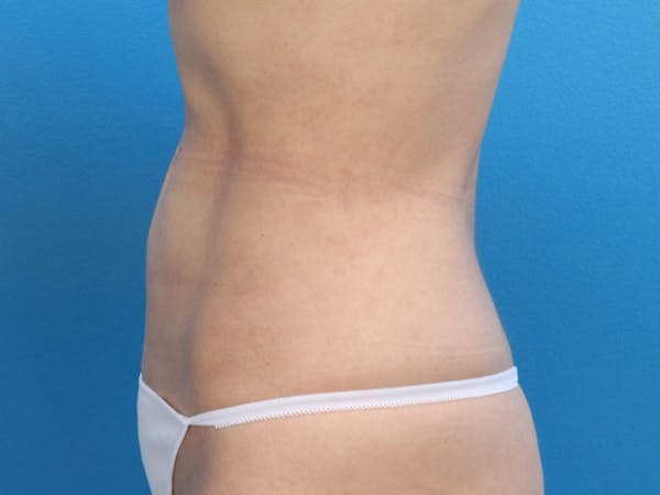 Liposuction Before & After Gallery - Patient 143825678 - Image 10
