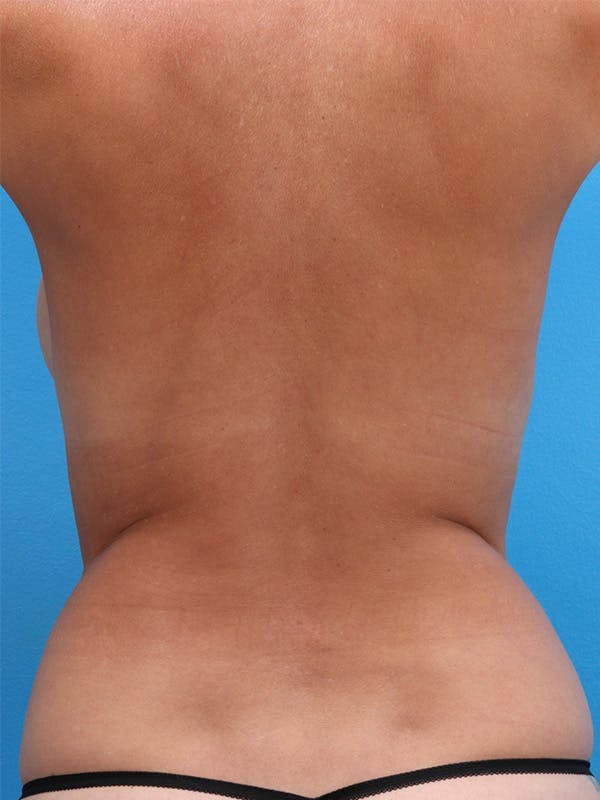 Liposuction Before & After Gallery - Patient 146224979 - Image 5