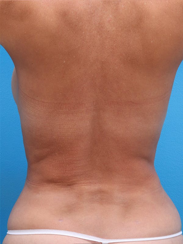 Liposuction Before & After Gallery - Patient 146224979 - Image 6