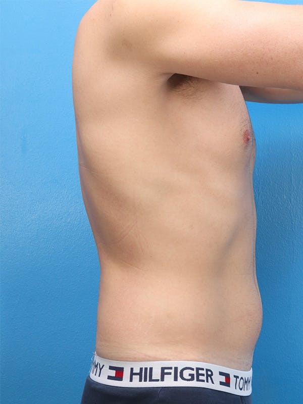 Liposuction Before & After Gallery - Patient 146224977 - Image 3