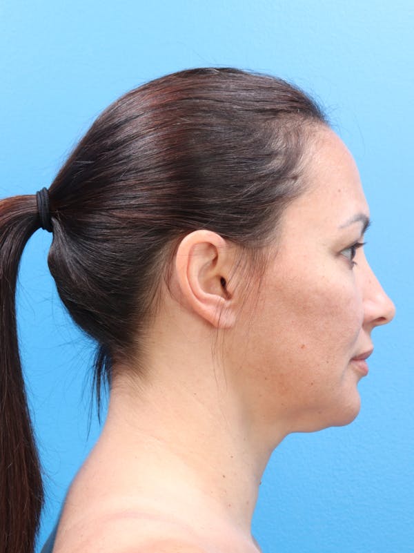 MyEllevate™ Before & After Gallery - Patient 140841192 - Image 5