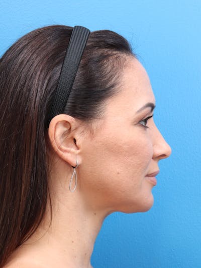 MyEllevate™ Before & After Gallery - Patient 140841192 - Image 6