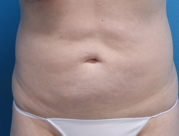 Liposuction Before & After Gallery - Patient 147124022 - Image 1