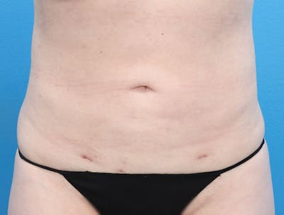 Liposuction Before & After Gallery - Patient 147124022 - Image 2