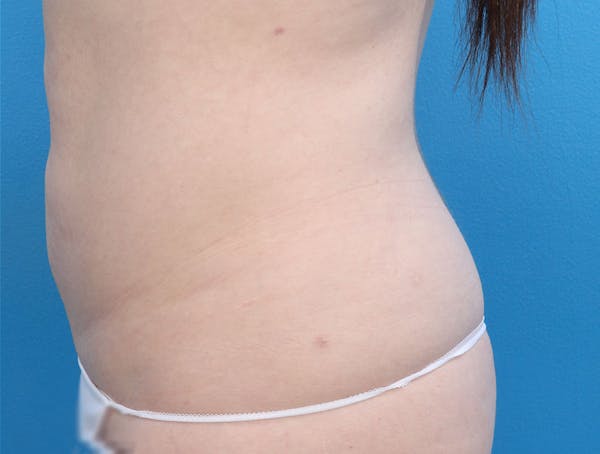 Liposuction Before & After Gallery - Patient 147124022 - Image 3
