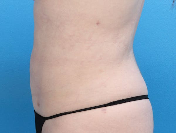 Liposuction Before & After Gallery - Patient 147124022 - Image 4