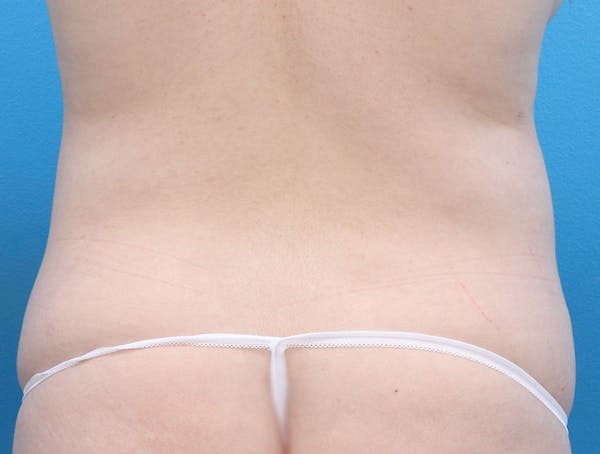 Liposuction Before & After Gallery - Patient 147124022 - Image 5
