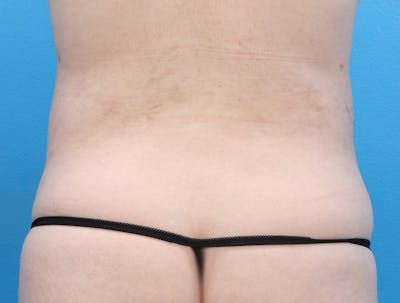 Liposuction Before & After Gallery - Patient 147124022 - Image 6