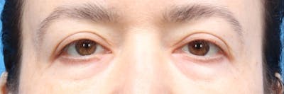 Blepharoplasty Before & After Gallery - Patient 147561238 - Image 1