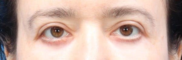 Blepharoplasty Before & After Gallery - Patient 147561238 - Image 2