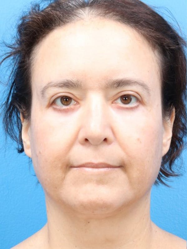 MyEllevate™ Before & After Gallery - Patient 146559208 - Image 3