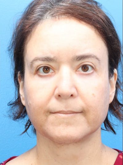 MyEllevate™ Before & After Gallery - Patient 146559208 - Image 4