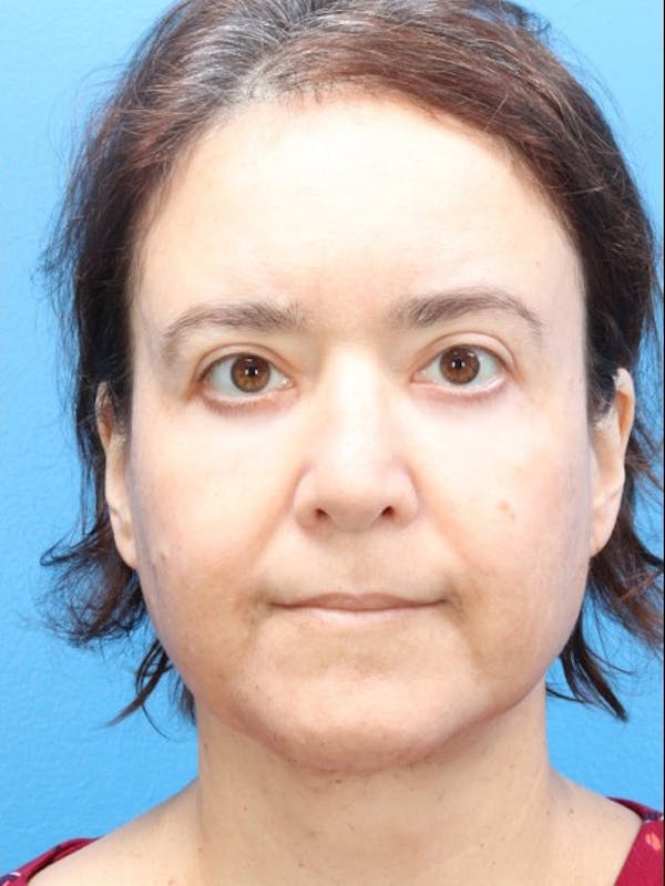 MyEllevate™ Before & After Gallery - Patient 146559208 - Image 4