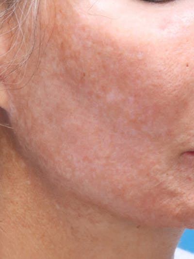 MOXI™ Laser Before & After Gallery - Patient 147561402 - Image 1