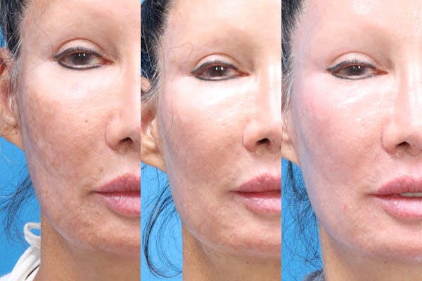 MOXI™ Laser Before & After Gallery - Patient 147561402 - Image 3