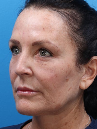 MOXI™ Laser Before & After Gallery - Patient 147561410 - Image 1