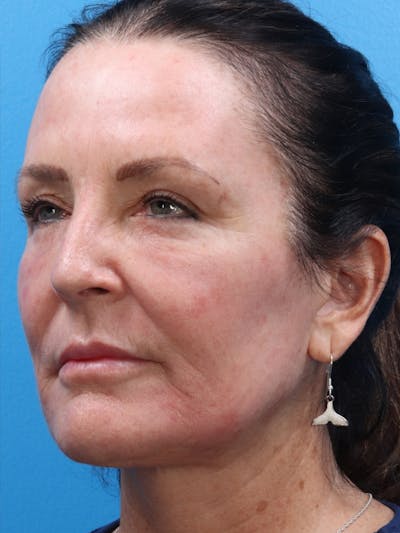 MOXI™ Laser Before & After Gallery - Patient 147561410 - Image 2