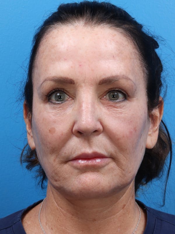 MOXI™ Laser Before & After Gallery - Patient 147561410 - Image 3