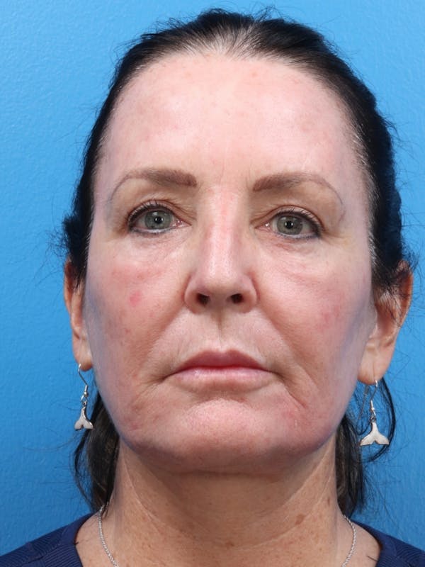MOXI™ Laser Before & After Gallery - Patient 147561410 - Image 4
