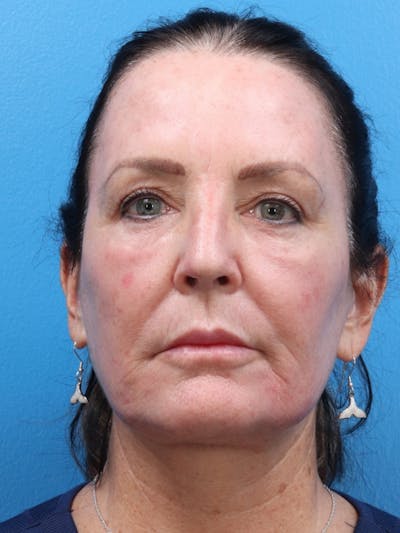 MOXI™ Laser Before & After Gallery - Patient 147561410 - Image 4