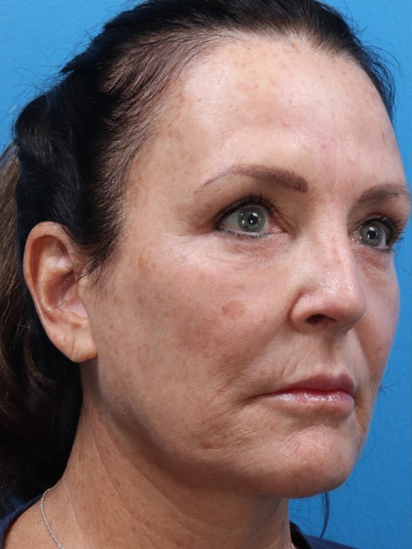 MOXI™ Laser Before & After Gallery - Patient 147561410 - Image 5