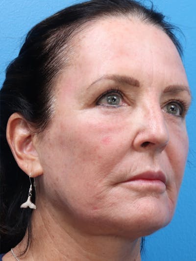 MOXI™ Laser Before & After Gallery - Patient 147561410 - Image 6
