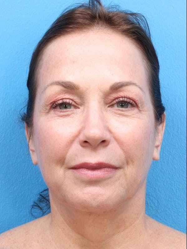MyEllevate™ Before & After Gallery - Patient 147561413 - Image 4