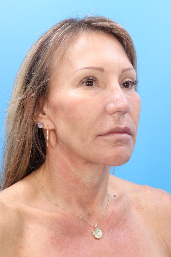 Ellacor Before & After Gallery - Patient 147644002 - Image 2