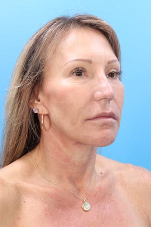 Ellacor in Boca Raton & West Palm Beach Before & After Photos
