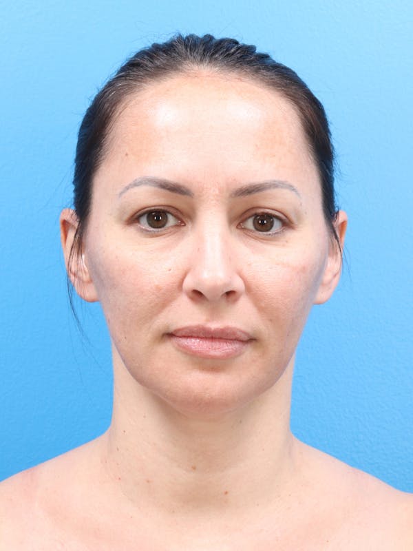 Blepharoplasty Before & After Gallery - Patient 140841189 - Image 1