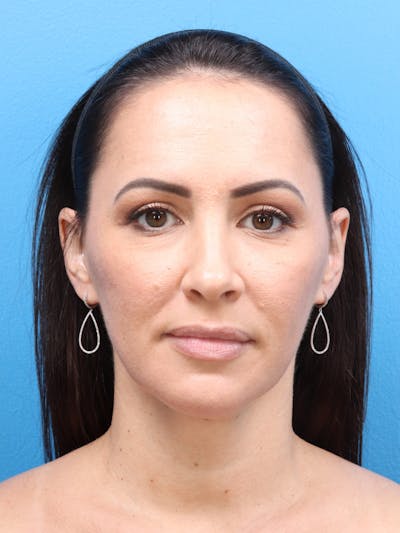 Blepharoplasty Before & After Gallery - Patient 140841189 - Image 2