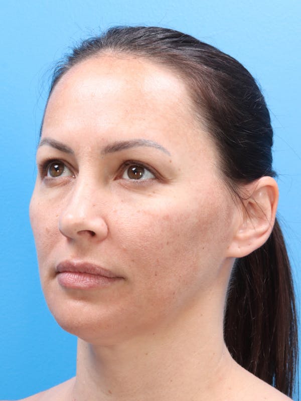Blepharoplasty Before & After Gallery - Patient 140841189 - Image 3