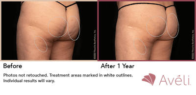 Aveli  Before & After Gallery - Patient 148073107 - Image 1