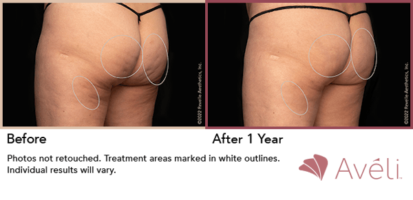 Aveli  Before & After Gallery - Patient 148073107 - Image 1