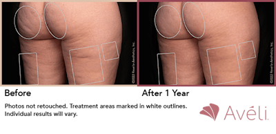 Aveli  Before & After Gallery - Patient 148073106 - Image 1