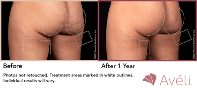 Aveli  Before & After Gallery - Patient 148073097 - Image 1