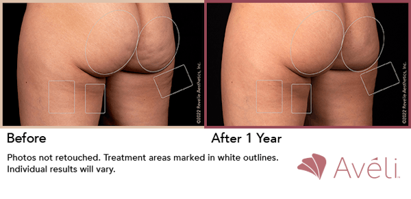 Aveli  Before & After Gallery - Patient 148073097 - Image 1