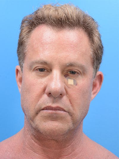 FaceTite Before & After Gallery - Patient 155774706 - Image 1