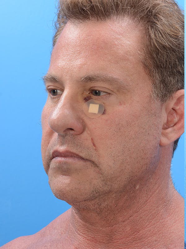 MyEllevate™ Before & After Gallery - Patient 155774705 - Image 3