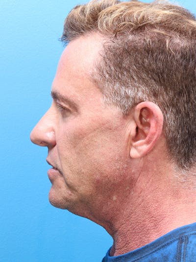 MyEllevate™ Before & After Gallery - Patient 155774705 - Image 6