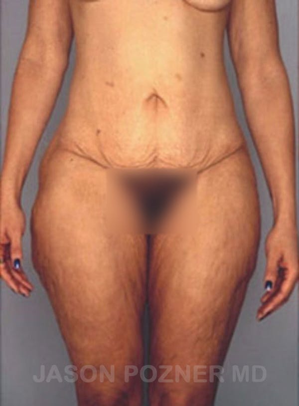Body Lift Before & After Gallery - Patient 17932075 - Image 1