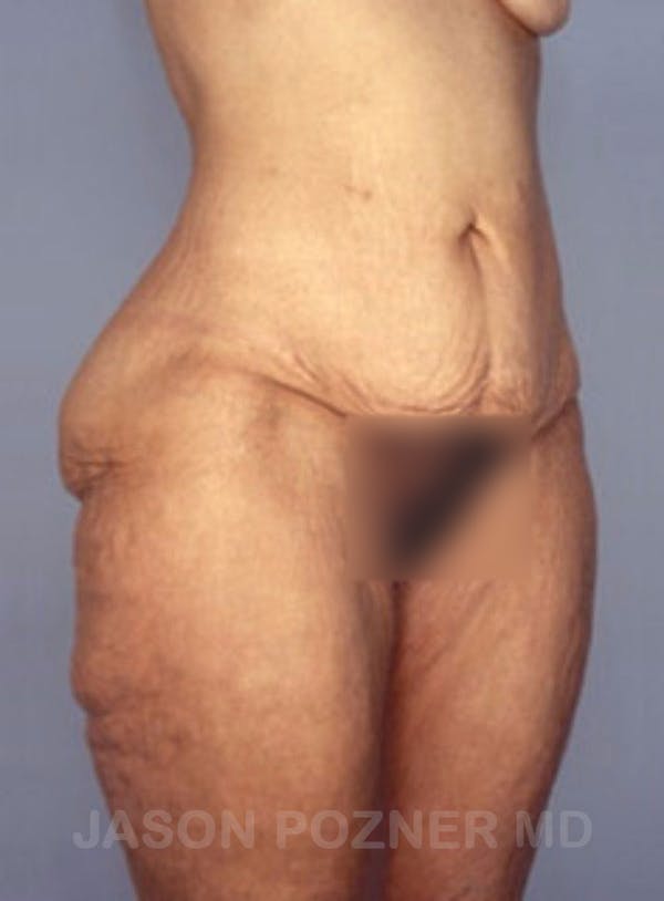 Body Lift Before & After Gallery - Patient 17932075 - Image 3